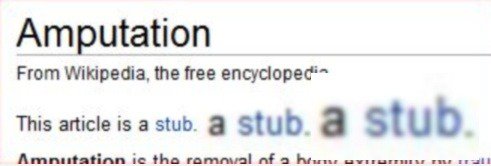 Wiki Amputation