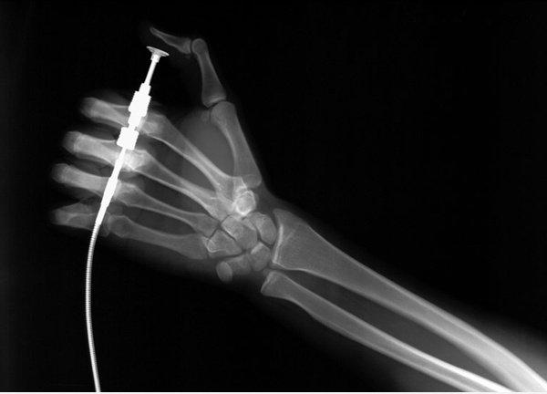Hand X-Ray
