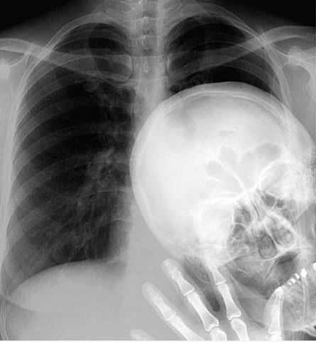 X ray bomb