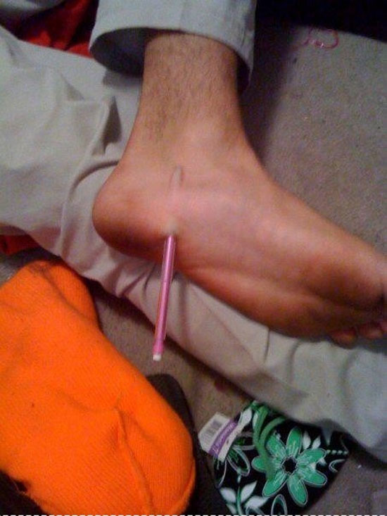 Wenn der Stift im Fuß steckt